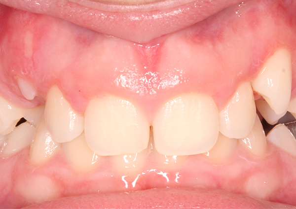 Before-Dental-3