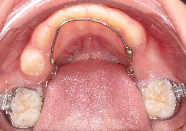 Before-Extracción prematuras