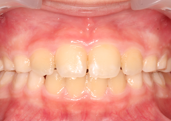 After-desviación mandibular